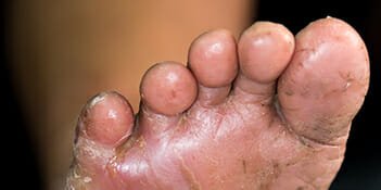 diabetic foot care treatments - Caledon and Kleinburg Foot Care Clinic