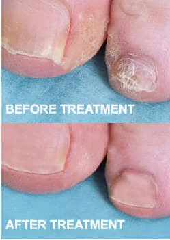 Nail-fungas-before-and-after